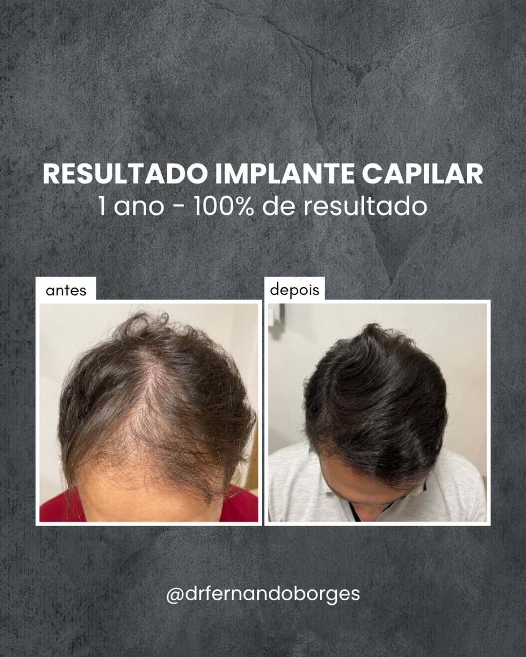 uploads/Neste caso, o transplante capilar proporcionou mais densidade e cobriu as falhas que tanto inco.jpg